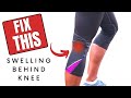 Pain behind Knee? - 4 Common types of Knee Cysts