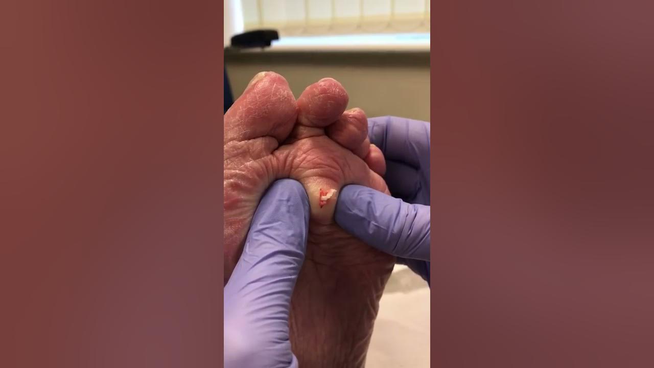 Video epidermal (sebaceous) cyst drainage from the plantar foot YouTube