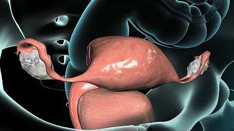 ¿Qué órganos se extirpan con una histerectomía?