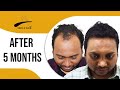 Patient Experience | Hair Transplant in Bhubaneswar | Dr Alok Sahoo