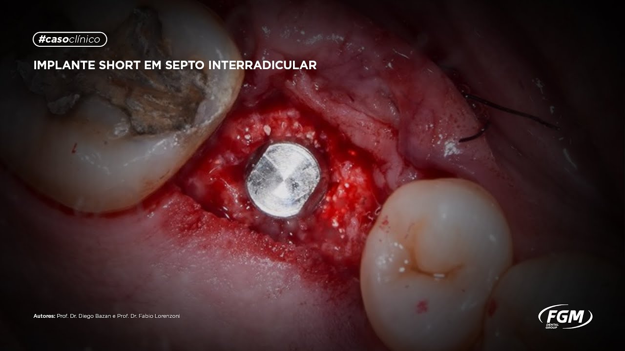 #casoclínico: Implante short em septo interradicular | FGM Dental Group ...