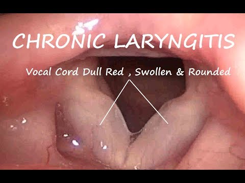 Laryngology : Chronic Laryngitis