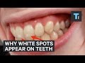 Here's why some people have white spots on their teeth