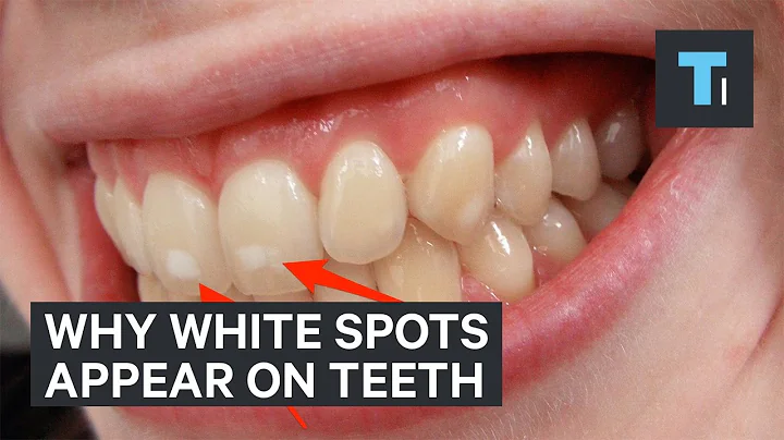 Here's why some people have white spots on their teeth - DayDayNews