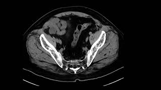 Appendix Mucocele
Speaker: Dr. Mahan Mathur, MD.
Associate Professor, Division of Body Imaging,
Vice Chair of Education, Dept of Radiology and Biomedical Imaging,
Yale School of Medicine. Appendix Mucocele