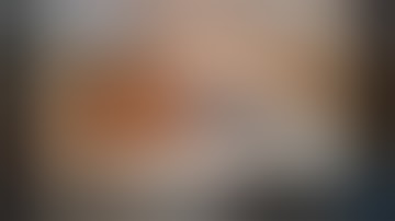 Basilar Tip Aneurysm Clipping by Iype Cherian :MD Nobel Medical Center