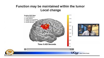 Changes in the Brain During Brain Cancer | UCSF Brain Tumor Center