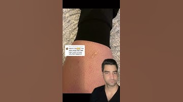 Lymphedema Leg Swelling