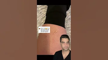 Lymphedema Leg Swelling 