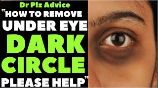 How to Remove DARK CIRCLES PERMANENTLY !!! ??Dr Plz Help ??