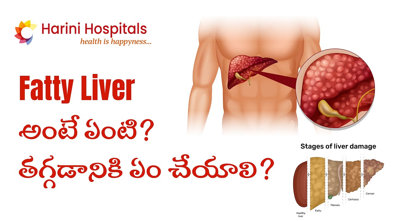 What is Fatty Liver? Naturally REDUCE Fatty Liver Disease #teluguhealthtips #doctor #healthtips