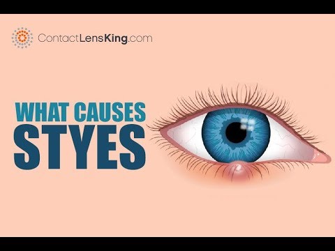 What Are Styes? Causes, Symptoms and Treatments