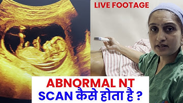 Abnormal NT Scan | Nuchal translucency (NT) scan | Live demo -Dr Asha Gavade