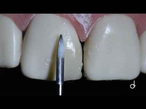 Video: İtlərdə Diş Sınığı