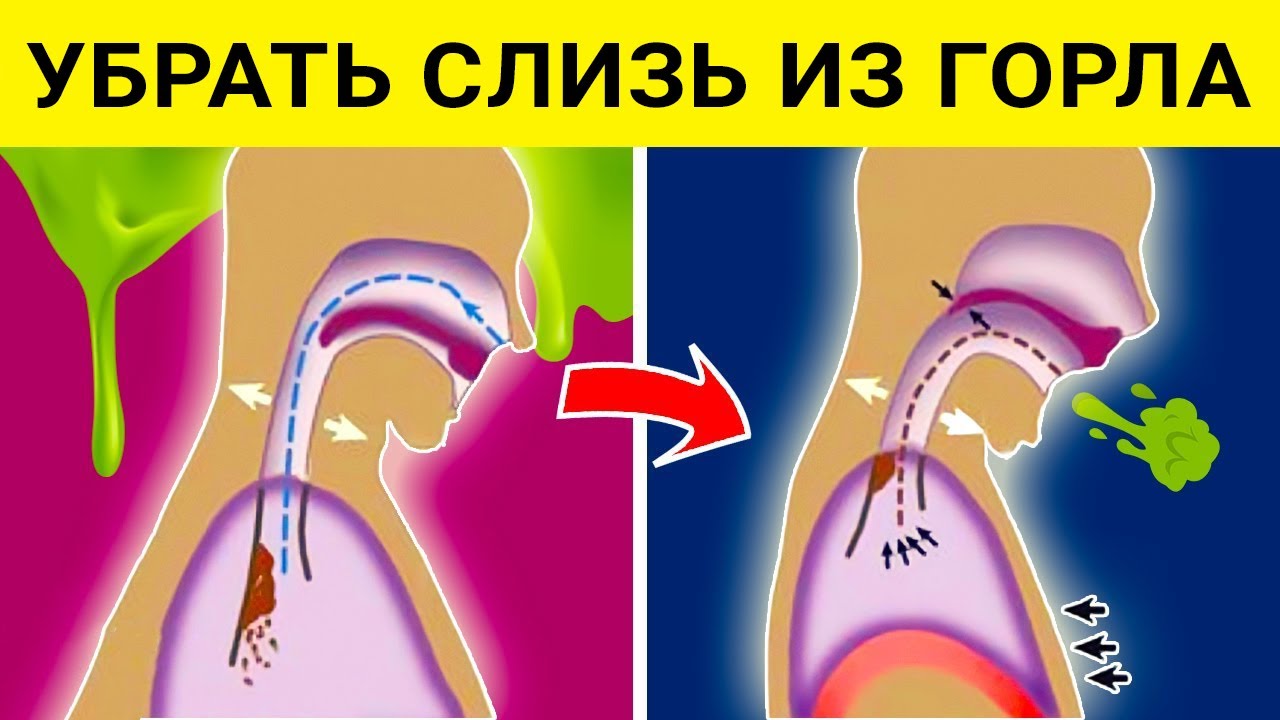 Как убрать мокроту из горла