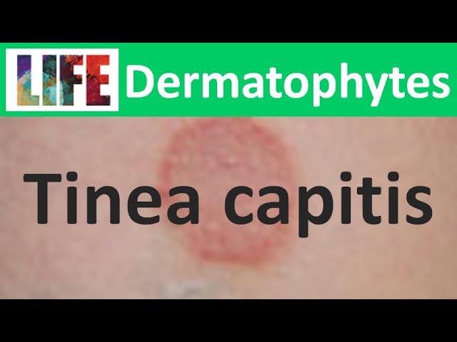 Tinea capitis (part 1/2) 