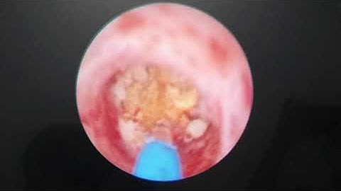 Hậu quả của sỏi niệu quản để lâu ngày.TS.BS. Dương Văn Trung ☎️0913534343.website:soithan.net.vn