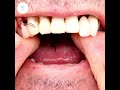 Dentures in bangalore  dentick dental care btm layout