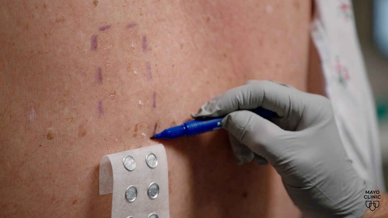 The future of skin allergy testing - YouTube