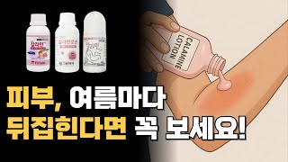 약사가 알려주는 칼라민 로션의 모든 것 | 땀띠, 벌레 물림, 화상까지