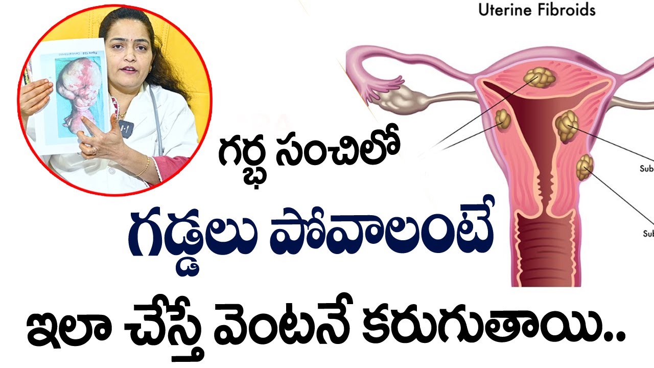 Uterine fibroids and treatments | Uterine Fibroid Symptoms in Telugu | Uterine Fibroid Treatment