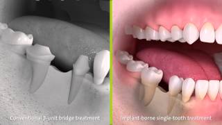 Dental Bridge Cost Estimate Types And Pros And Cons