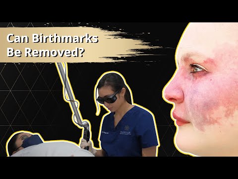 Can Birthmarks Be Removed? | Radium Medical Aesthetics