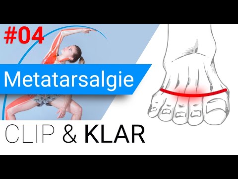 Metatarsalgie erklärt - druckschmerzhafte Zehengrundgelenke