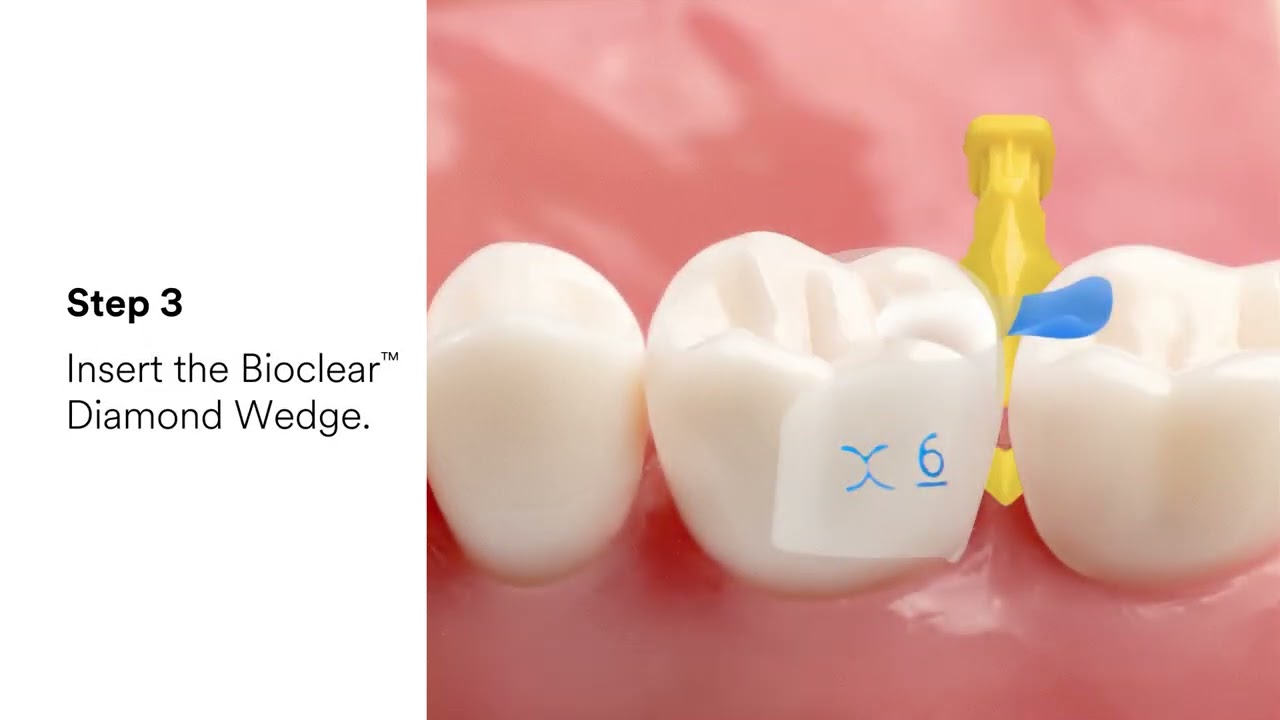 The 2-Point Spot Weld Class II Animated Video