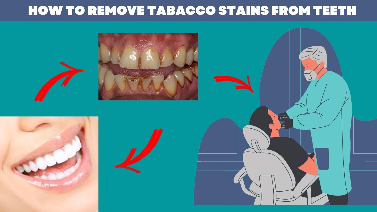 how-to-clean-tobacco-stains-from-teeth-fast-easily-youtube