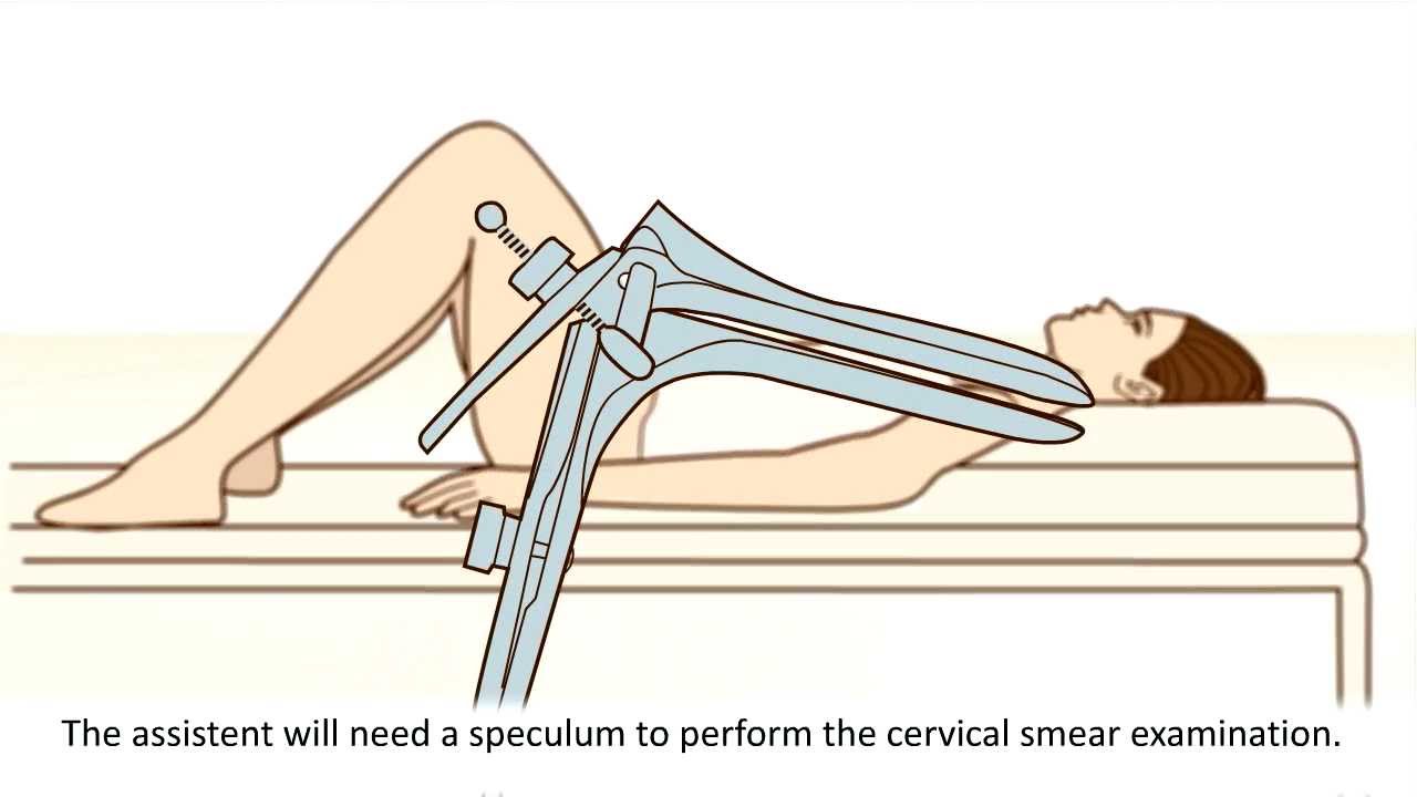 A Cervical Screening Test - What Can You Expect - Youtube-4110