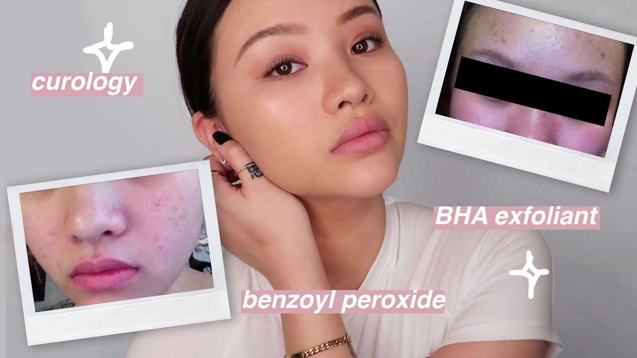 How To Actually Get Rid Of Acne Texture Bumps And Clear Ur Skin Forever Youtube