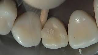 Class III Composite Preparation & Restoration | Operative Dentistry