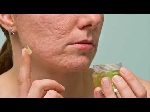 Natural And Effective Treatment For Acne During Pregnancy Is Honey- How To Use