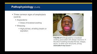 Chp 21   Allergy and Anaphylaxis