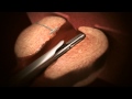 The urolift system animation in norwegian