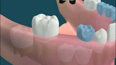 Dental Video for Space Maintainer - The Tooth