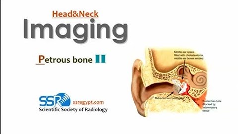 Imaging of Petrous bones (II) (DRE) Prof. Mamdouh Mahfouz