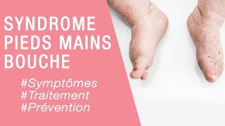 Le Syndrome Pieds Mains Bouche Maladies Infantiles Youtube