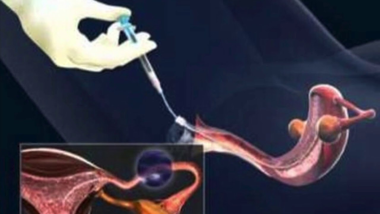 ARTIFICIAL INSEMINATION YouTube