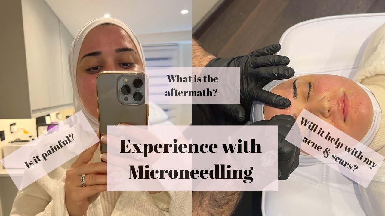 my-experience-with-microneedling-journey-to-remove-my-acne-scars