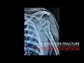 Complex Shoulder Fracture with Dislocation Surgery