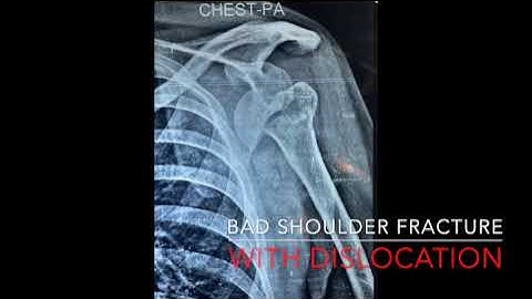 Complex Shoulder Fracture with Dislocation Surgery