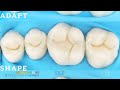 Replica technique, a simplified technique for making occlusal modeling predictable and easy