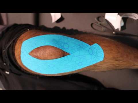 Myofascial Treatments and Kinesiology Taping Techniques for Knee Osteoarthritis