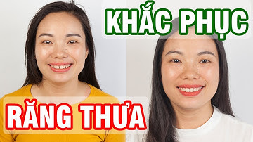 Mặt dán sứ veneer khắc phục khe thưa, siêu mỏng, nhỏ, bền, đẹp, hiệu quả  100%