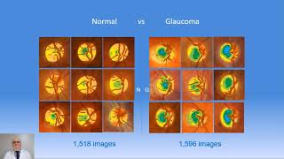 A glaucoma screening study analyzing 200,000 optic nerves using the RetinaLyze Glaucoma program News