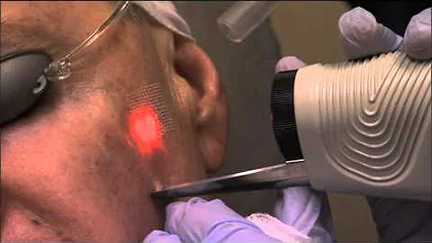 Laser Skin Rejuvenation