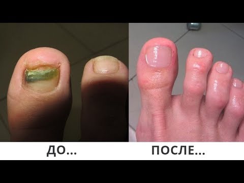 Грибок Ногтей На Ногах Фото