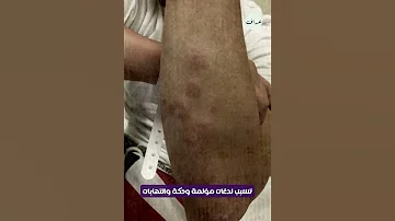 باريس في خطر كيف تحولت مدينة الأحلام إلى مدينة الكوابيس بسبب غزو حشرة البق 